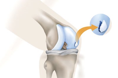 osteochondritis-dessicans-od