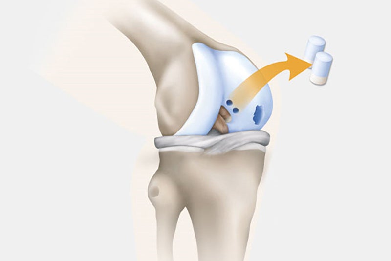 cartilage-extracted