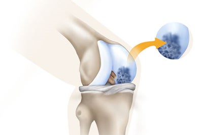 degenerative-cartilage-defects