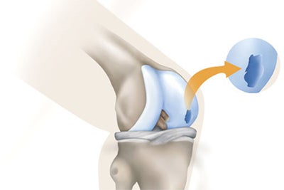 traumatic-cartilage-injuries