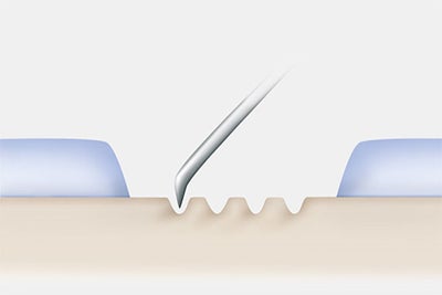 Illustration showing marrow simulating technique